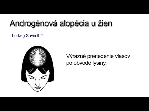 Video: Androgénna Alopécia U žien - Liečba, Prognóza