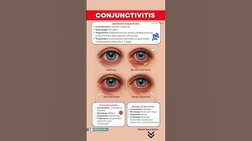 Conjunctivitis - Viral, Bacterial and Allergic – Symptoms, Causes & Treatment | Pink Eyes