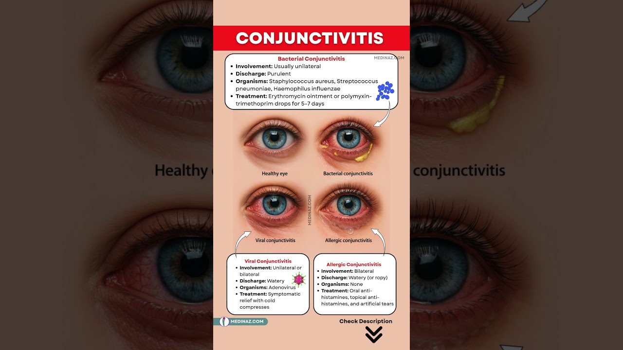 Conjunctivitis - Viral, Bacterial and Allergic – Symptoms, Causes & Treatment | Pink Eyes