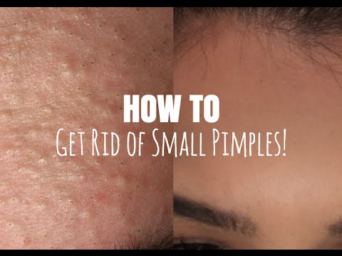 How do you get rid of pimples on your forehead?