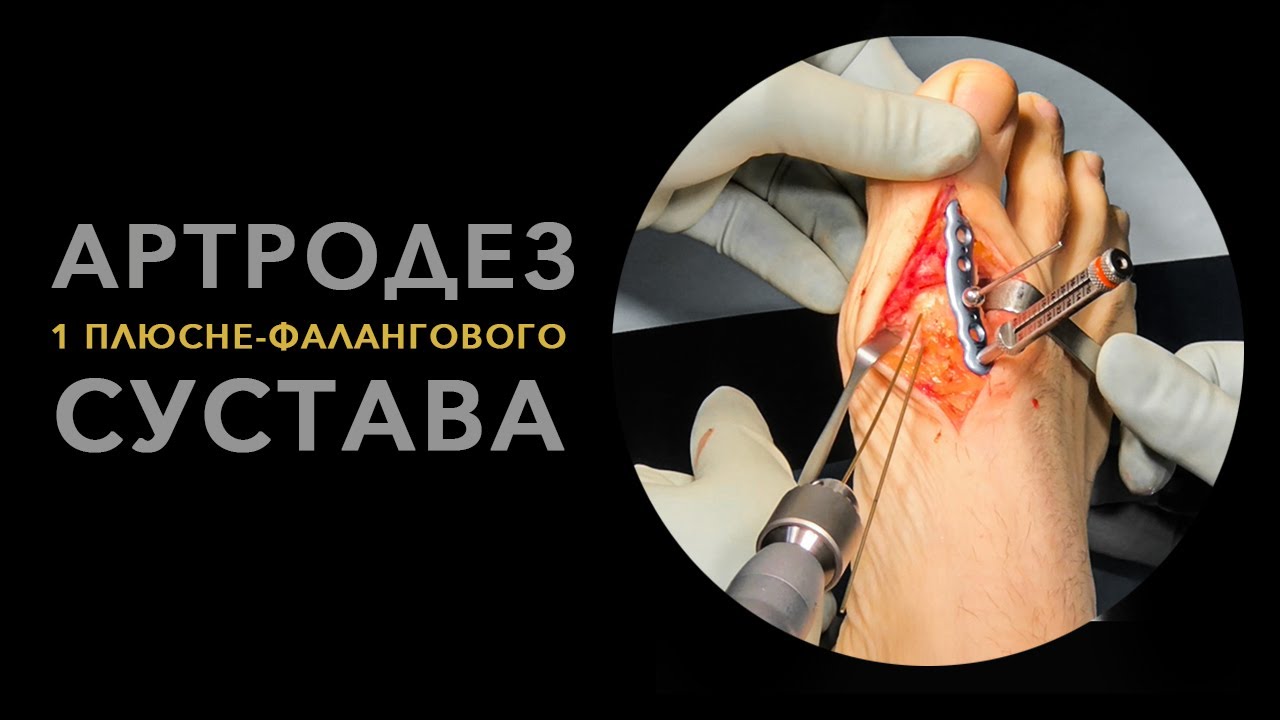 Артродез первого плюснефалангового сустава