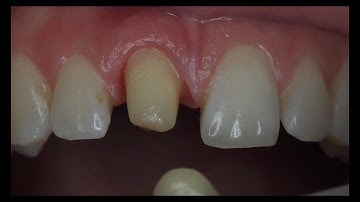Subgingival preparation and nonsurgical gingival contouring with a temporary restoration