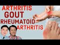 Arthritis, Gout at Rheumatoid Arthritis - Payo ni Doc Gary Sy at Doc Willie Ong #3c