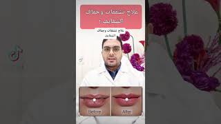 تشققات وجفاف الشفايف اسبابها وعلاجها #lipstick