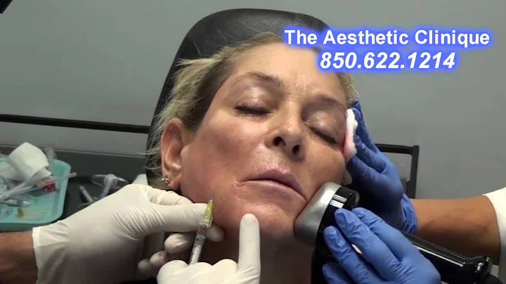 Liquid Facelift using blunt cannulas, Aesthetic Cl...