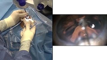 Kahook Dual Blade Instructional Video - Nathan Radcliffe, MD