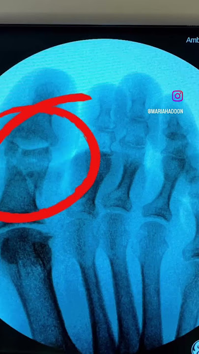 Can You Find the Break? #drhaddon #oakhillpodiatryresidents #podiatry