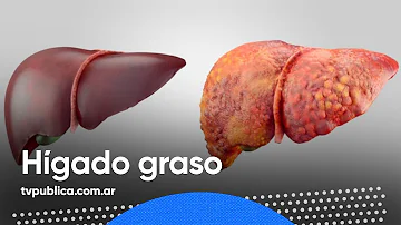 ¿Como luce un hígado graso?