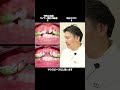 捻れた前歯 歯列矯正 矯正歯科 Shorts 捻れた前歯 歯列矯正 矯正歯科 Shorts