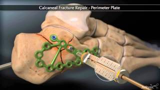 Calcaneal Fracture Perimeter Plate