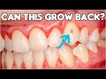 Can Tooth Enamel Grow Back? (How To Prevent Enamel Erosion)