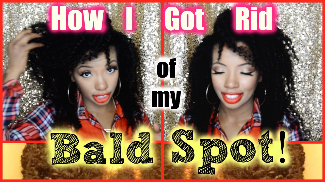 How I Got Rid of My Bald Spot! (before/after pics) - YouTube