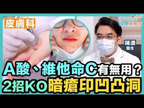 Video 【暗瘡印消除】洗米水、維他命C、A酸有無用？2招KO暗瘡印、凹凸洞＋4個預防貼士 - youtube