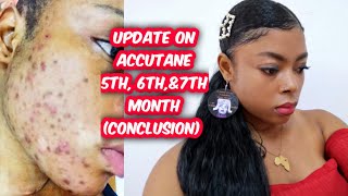 5th, 6th, 7th month update on accutane (isotretinoin)(pictures) | Conclusion of my accutane journey