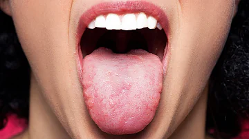How do I get rid of plaque on my tongue?