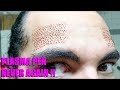 NEVER AGAIN !!! Eyebrow Lifting With Plasma Pen Fibroblast Dermapen Treatment