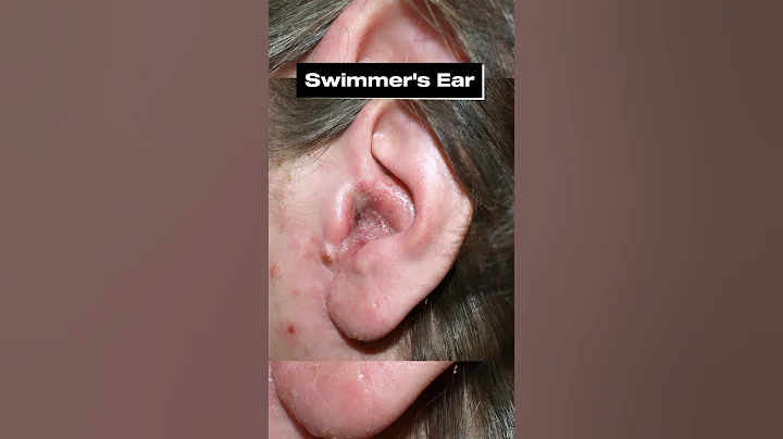 The #1 Worst Thing to Do for Ear Pain (Best Way to Avoid Swimmer’s Ear) - DayDayNews