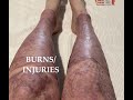 My burns / injuries