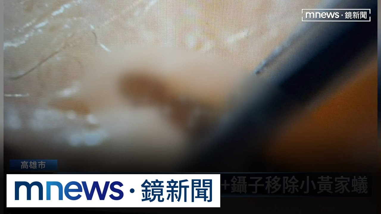 8歲男童午睡眼爆痛　活螞蟻鑽眼睛緊咬眼皮｜#鏡新聞