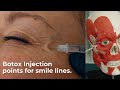Botox injection points for smile lines