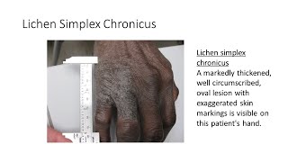 Lichen Simplex Chronicus by House Job 35 views 1 month ago 1 minute, 32 seconds