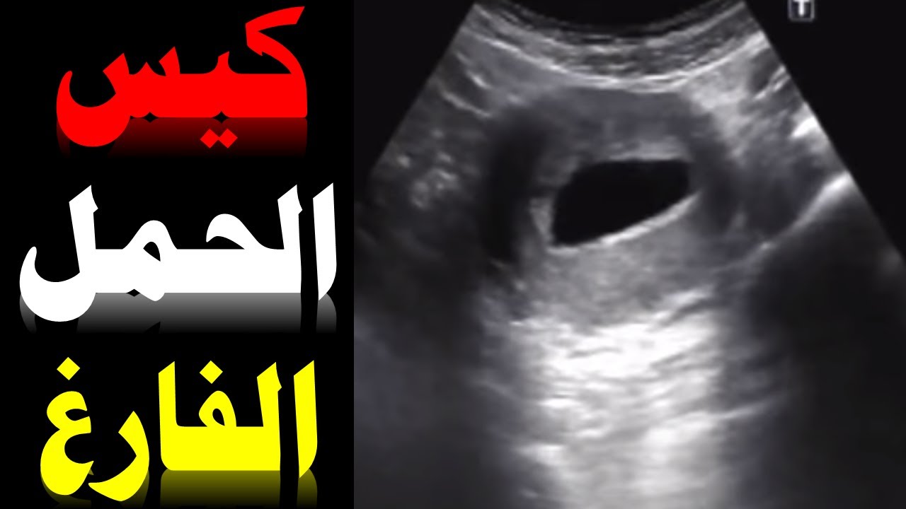 كيس الحمل الفارغ كيس حمل بدون جنين دكتور يوسف عيد Blighted Ovum Youtube