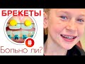 6 этапов установки БРЕКЕТОВ. БОЛЬНО ЛИ? / MARGOLANDIA