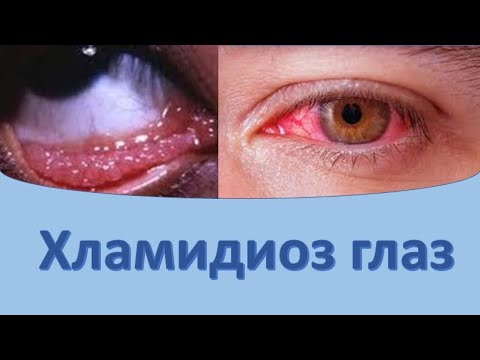 Хламидиоз глаз