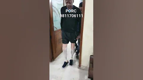 #belowkneeamputee #bothlimb #prosthesis #motivation #artificiallimb #prosthesiscenter #ossur