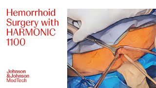 Left Lateral Hemorrhoidectomy Using Harmonic 1100 Shears With Ali Mahmood, Md Jj Medtech