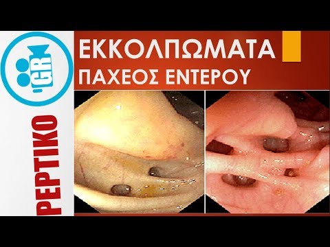 Εκκολπώματα παχέος εντέρου, εκκολπωματίτιδα - peptiko.gr