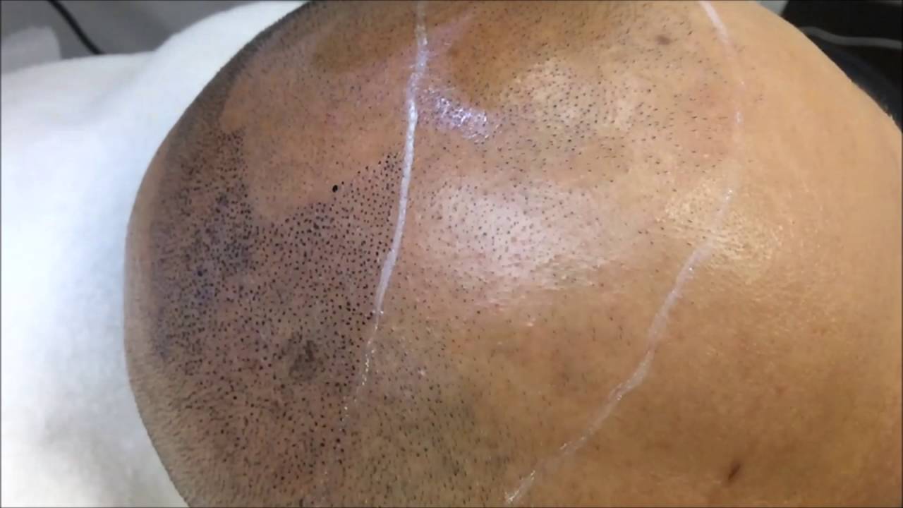 Scalp Micropigmentation Needles Permanent Makeup Needles Vs SMP Needles YouTube