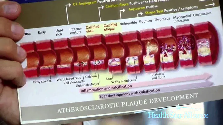 Detection and Prevention of Cardiovascular Disease