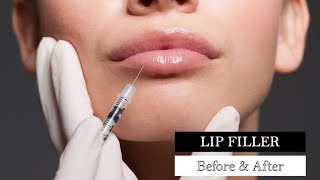 LIP FILLER INJECTIONS - Before and After