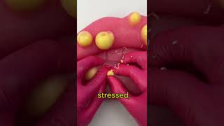 The CRAZIEST Truth About Pimples You Never Knew!