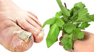 Cure Toenail Fungus For Less Than $1 in under 1 minute You must do it Herbs