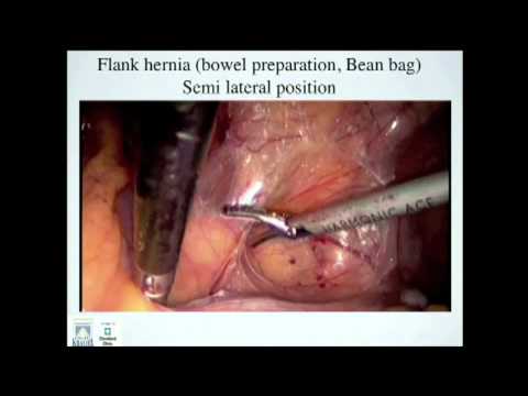 SAGES Top 21 Videos: Laparoscopic Ventral Hernia Repair