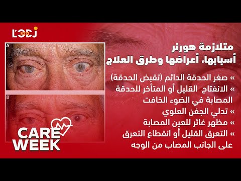   متلازمة هورنر أسبابها أعراضها وطرق العلاج