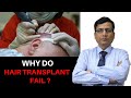 Why Do Hair Transplant Fail? जानिए  कारण |Indore| - Dr. Anil Garg ISHRS, ABHRS, AHRS