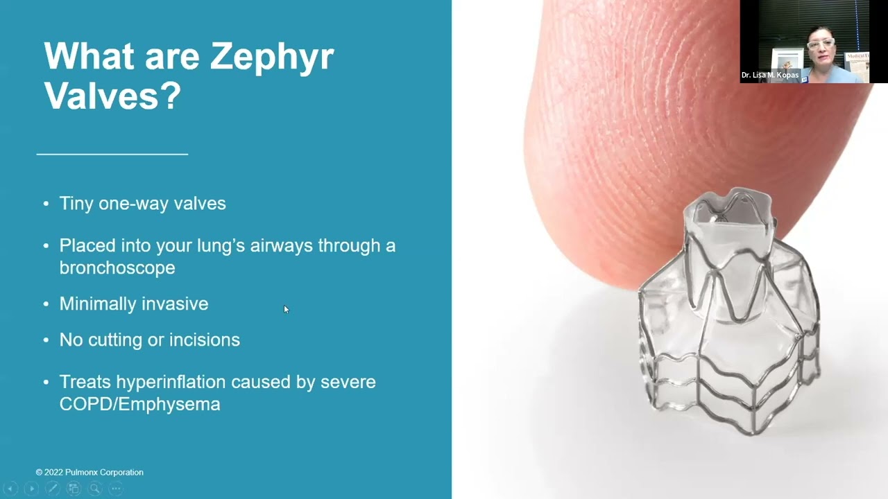 How Long Do Zephyr Valves Last How Zephyr Valve Works at Faith Fussell blog