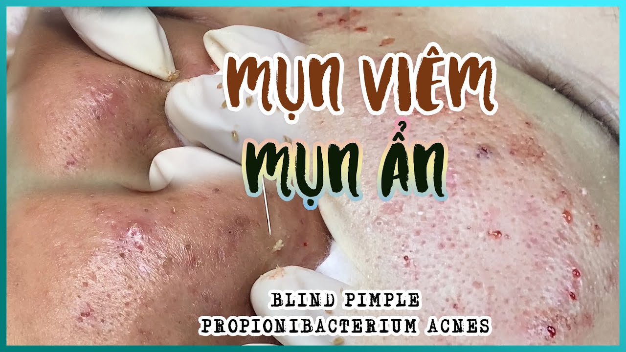 Big Cystic Acne Blackheads Extraction Blackheads & Milia, Whiteheads Removal Pimple Popping