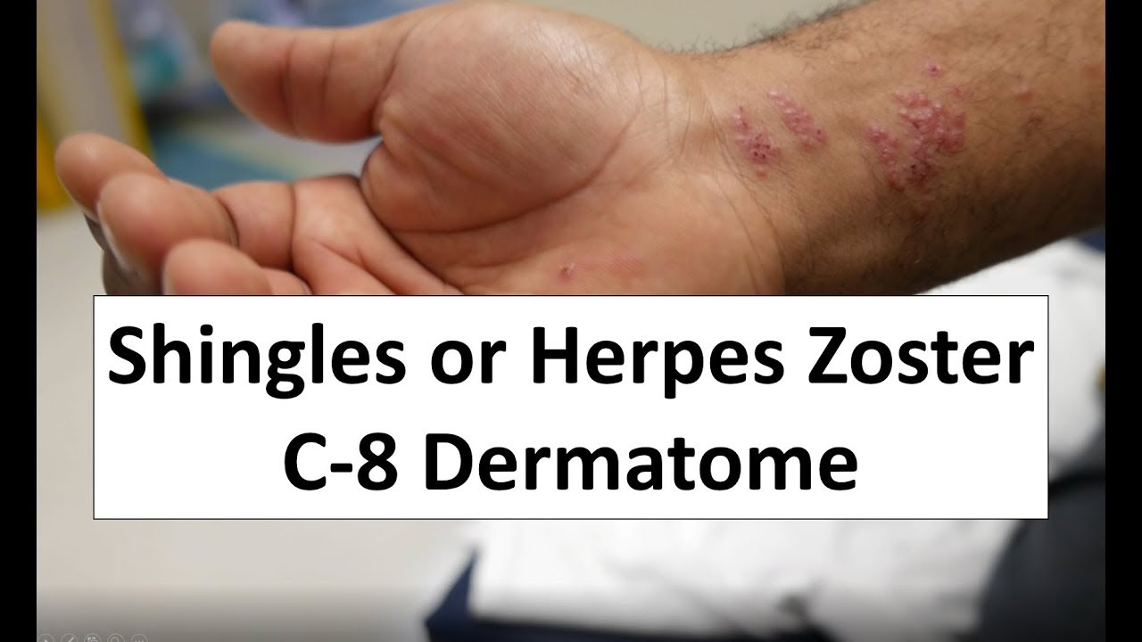 Shingles of the C8 Dermatome YouTube