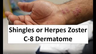 Shingles of the C-8 Dermatome