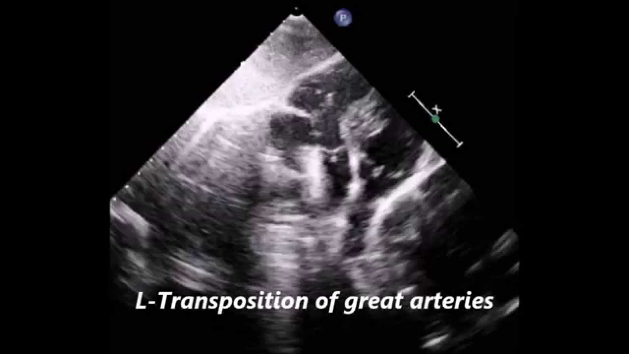 Triple inversion in congenital heart disease YouTube