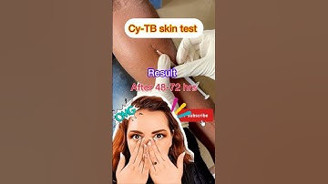 Cy-TB skin test | Tuberculosis | is this positive? #shortsfeed #youtubeshortsfeed