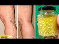 Eliminar Las Varices Rápidamente Con Esta Mezcla || Sólo 4 Ingredientes