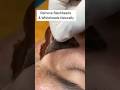Remove Blackheads Permanently At Home | Blackheads Removal Eady Tips 😱 Clear Glass Skin #ytshorts