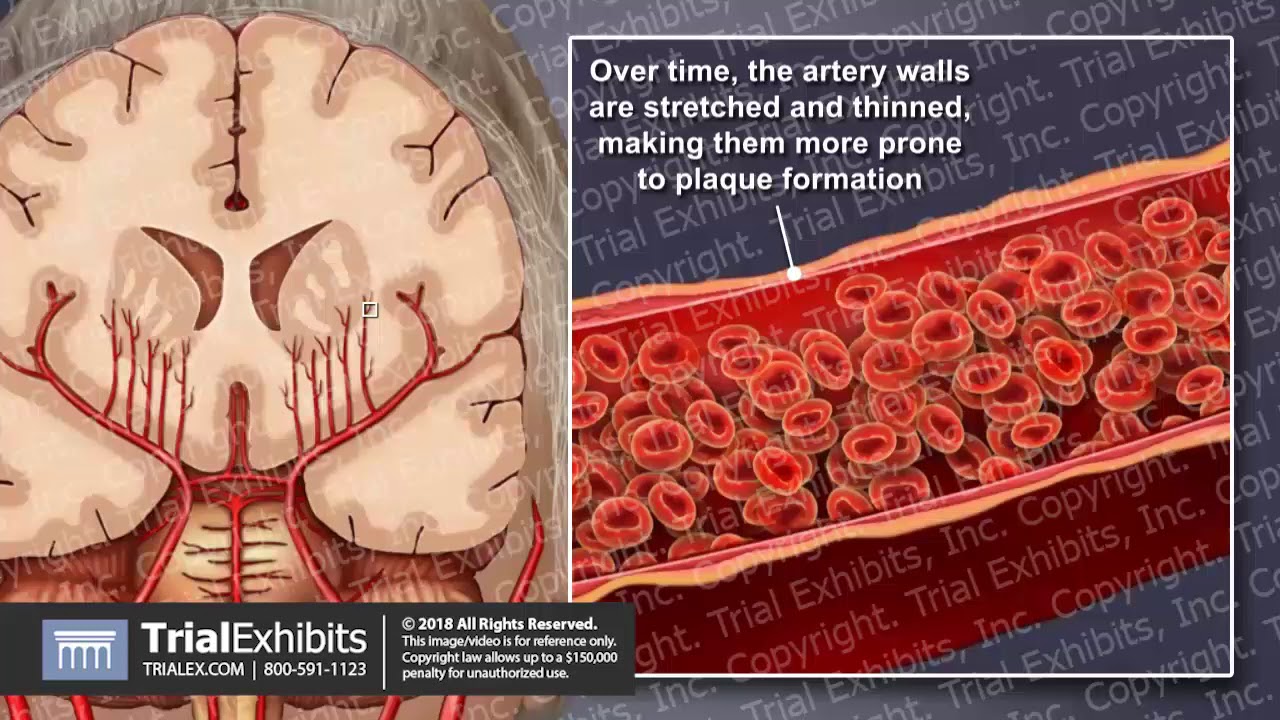 Cerebral Small Vessel Disease Leading to Ischemic Stroke - YouTube