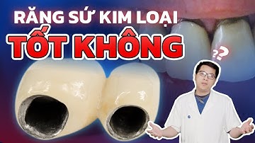 Răng Sứ Kim Loại Có Tốt Không? 3 Nhược Điểm "Chí Mạng" Cần Biết Trước Khi Làm Răng Sứ