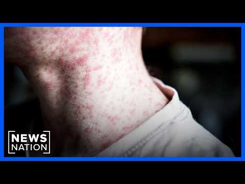 Measles cases reach highest level in U.S. since 1991